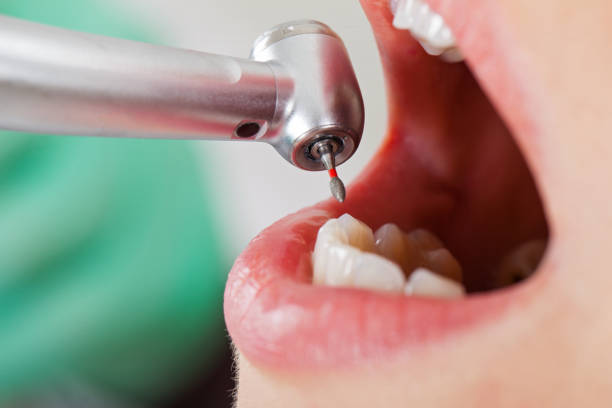 Best Root Canal Emergency Dentist  in Shorewood Forest, IN